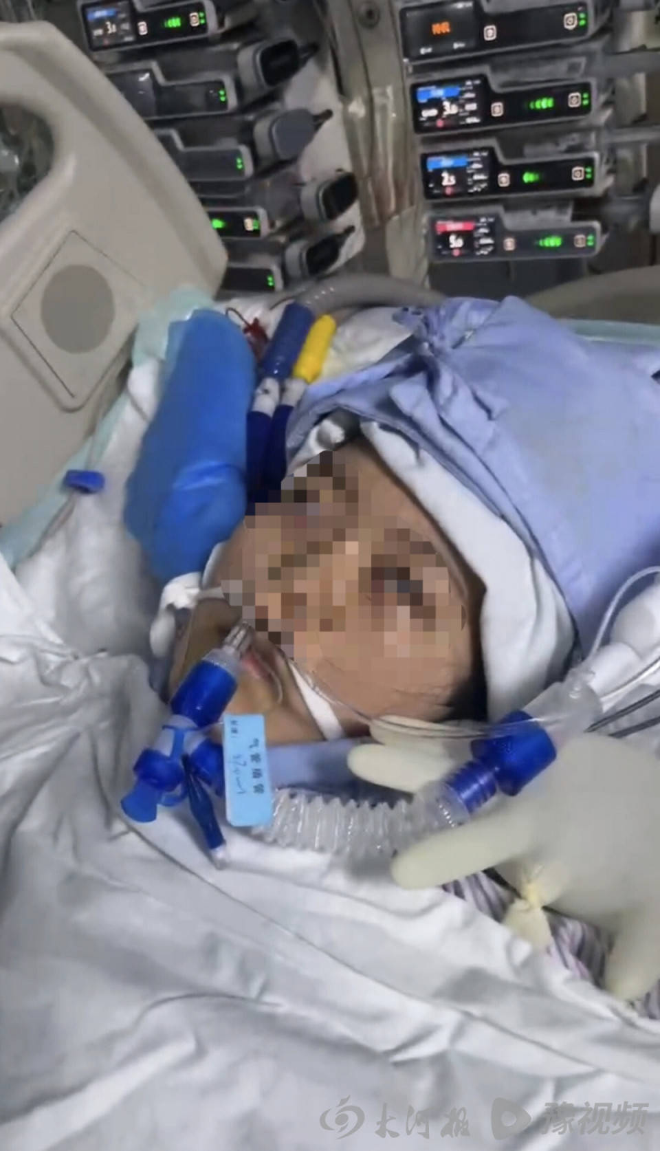 22岁美甲师手术成功却在复苏室脑死亡<strong></p>
<p>天干</strong>，家属称缺氧30分钟监护医生未察觉，医院回应