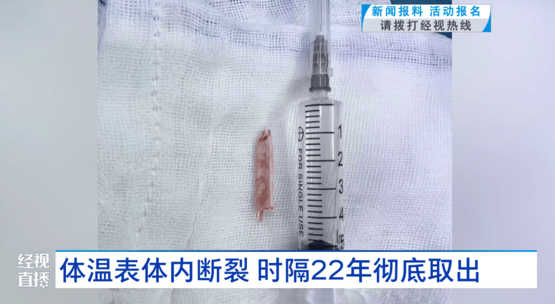 体温表在体内断裂<strong></p>
<p>欧易官方网站最新</strong>，女子时隔22年彻底取出！医生：庆幸水银不在里面
